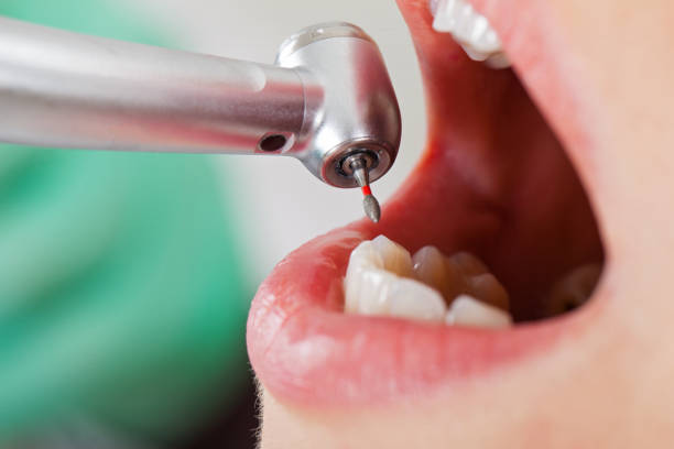 Best Dentist for Tooth Abscess  in Fort Pierce South, FL